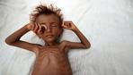 Mehr als 460.000 Kinder im Jemen in akuter Gefahr