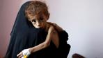 20 Millionen Menschen im Jemen hungern