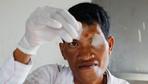 Forscher warnen nach US-Kürzungen vor Millionen neuer Malaria-Fälle