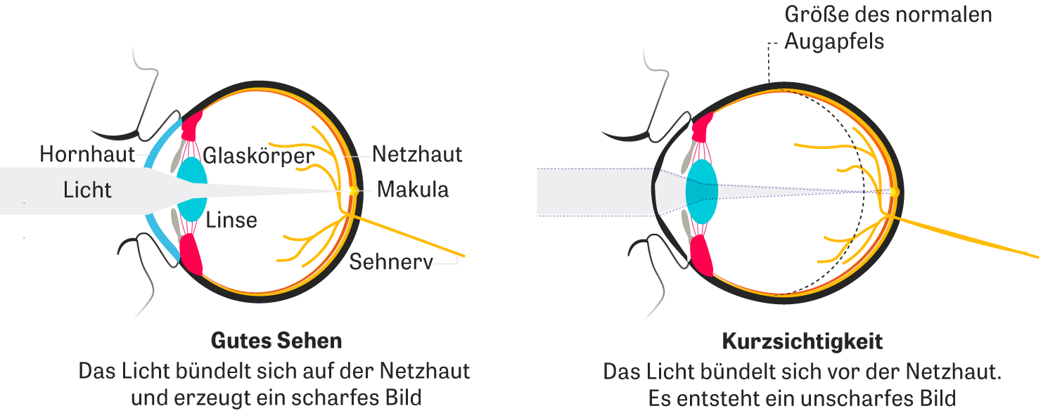 Kurzsichtigkeit Generation Sehschwache Zeit Online