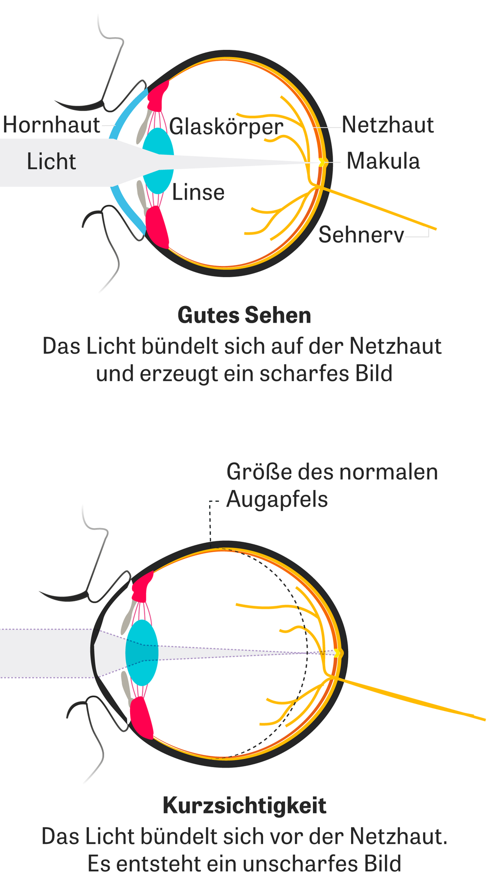 Kurzsichtigkeit Generation Sehschwache Zeit Online