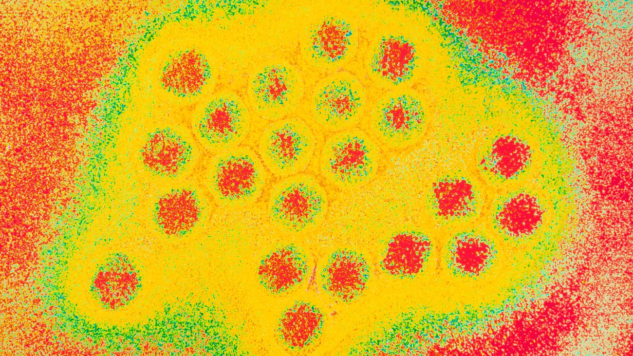 Rhume : Adénovirus – un rhume arrive rarement seul