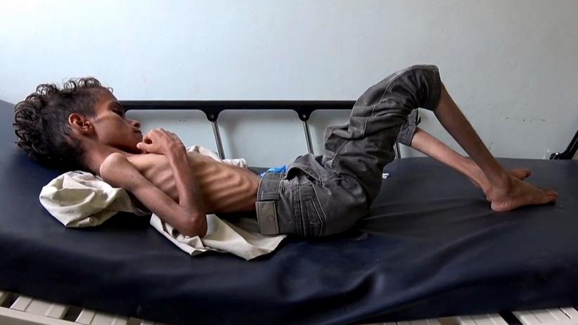 Nahrungsknappheit: Ein zehnjähriges an Unterernährung leidendes Kind im Bürgerkriegsland Jemen