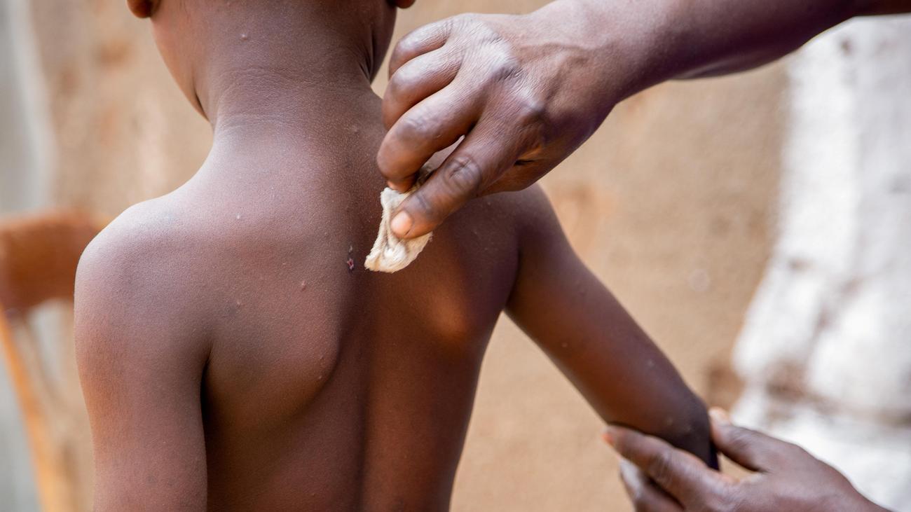 Virus Mpox : L’Unicef ​​lance un appel d’offres d’urgence pour le vaccin Mpox