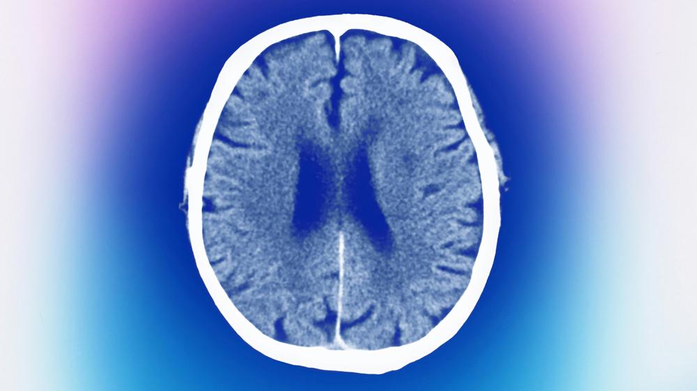 Stem cell therapy: "We want to repair the brain with these cells"says neurosurgein Viviane Tabar.