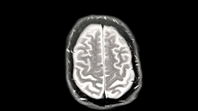 Leqembi: Was Sie zum neuen Alzheimer-Medikament wissen müssen