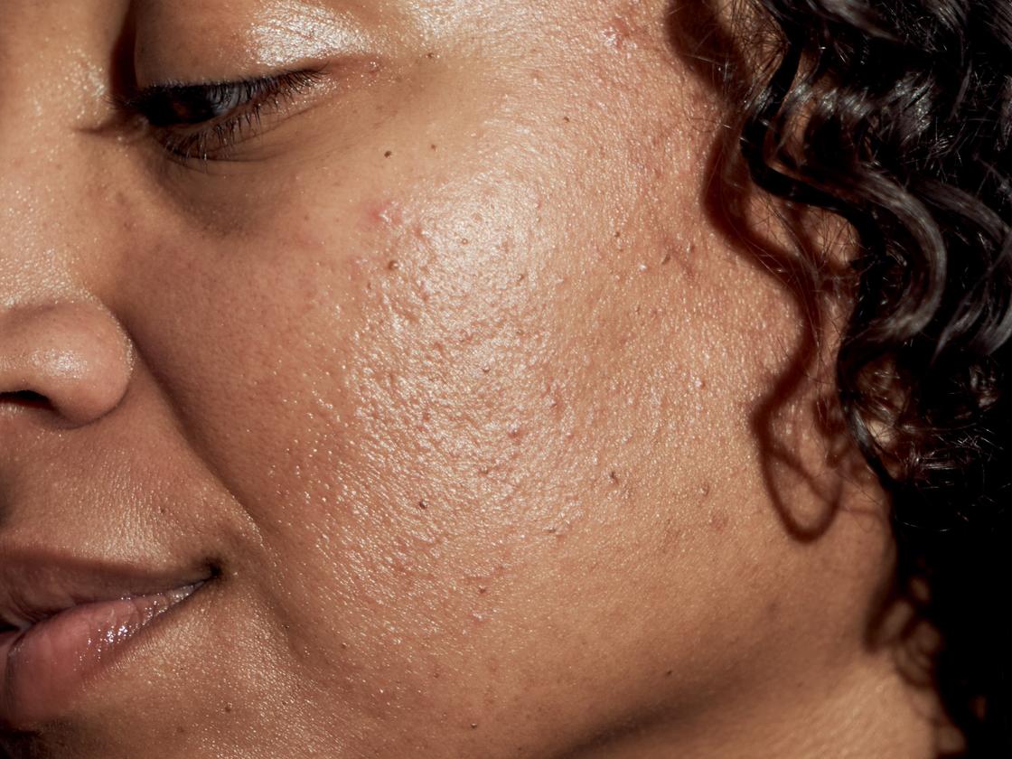 Isotretinoin Rezeptfrei Österreich