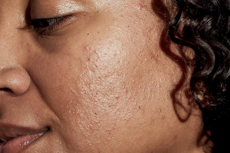 Isotretinoin in den usa kaufen