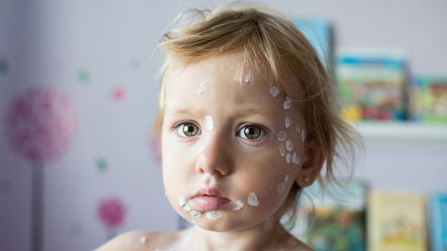 Masern: Masernfälle in Europa sinken deutlich, WHO bleibt dennoch besorgt