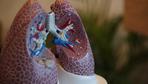 Lungenkrebs: Neue Hoffnung in Pillenform