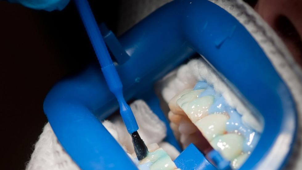 Mehr Schaden als Nutzen?: Bleaching-Produkte: Was macht die Zähne ...