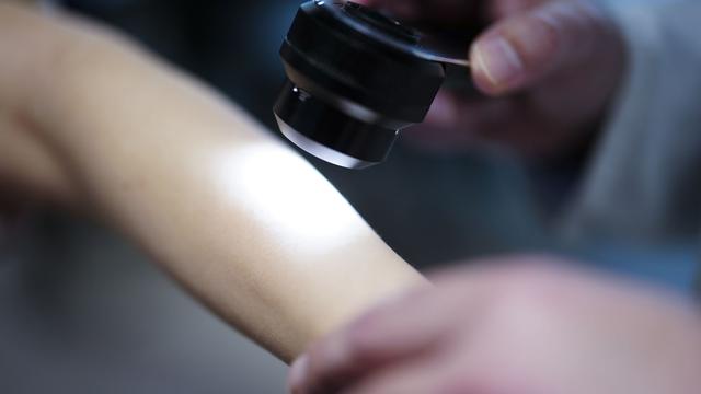 Gesundheit: Verband fordert staatlich organisiertes Hautkrebs-Screening