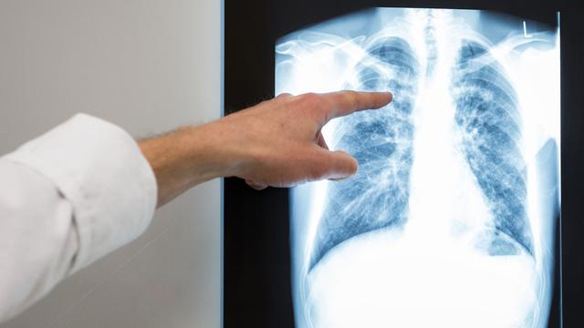 Gesundheit: Bislang 16 Tuberkulose-Fälle in diesem Jahr gemeldet