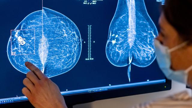 Gesundheit: Experten empfehlen Brustkrebs-Früherkennung ab 45 Jahren