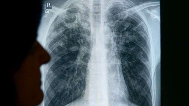 Gesundheit: Tuberkulose-Erkrankungen in Sachsen konstant