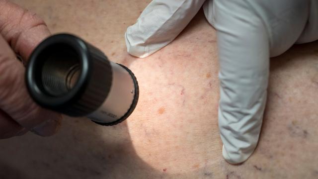 Hautkrebs: Deutliche Zunahme bei Hautkrebs-Erkrankungen in MV