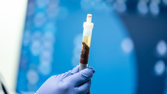 Infektionskrankheit: Pestinfektion in Kalifornien nachgewiesen