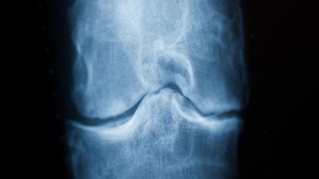 Gesundheit und Medizin: Rheuma-Aktionsplan soll Diagnose und Therapie beschleunigen