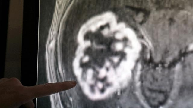 Todesursachen: Lungentumore sind bei Frauen und Männern häufigster Krebstod