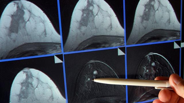 Erkrankungen: Keine Scheu vor dem Screening: Aufruf zu Früherkennung