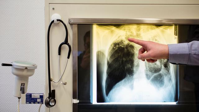 Infektionskrankheit: Tuberkulose bei Kind - Experte erwartet zügige Aufklärung