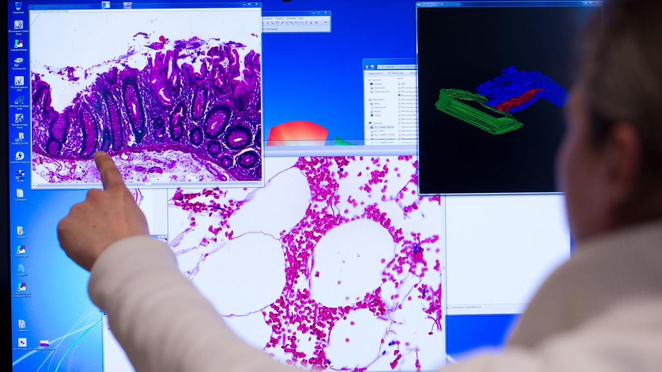 Aufruf zur Früherkennung: 8.000 Menschen in Bayern erkranken pro Jahr an Darmkrebs