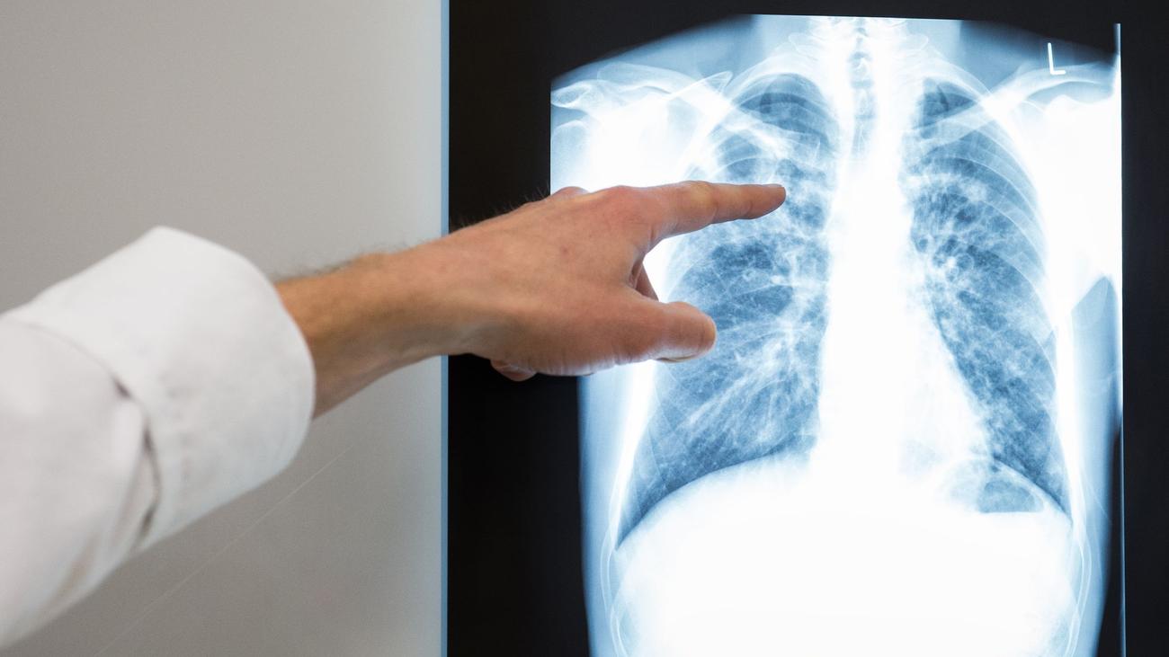 Über 100 Menschen: Tests nach Tuberkulose-Fall in Hohen Neuendorf