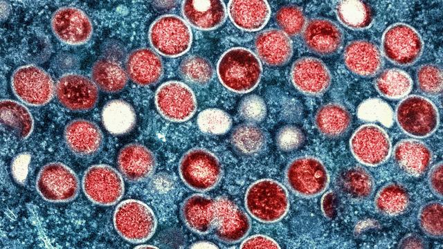 Seltene Krankheit: Mpox weitet sich in Berlin auf weitere Personengruppen aus
