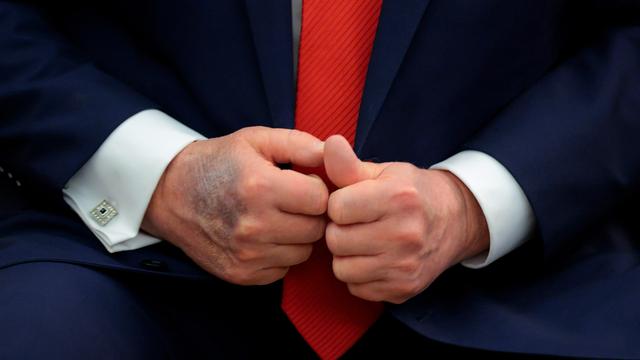 USA: Erneuter Bluterguss sorgt für Spekulation über Gesundheit von Trump