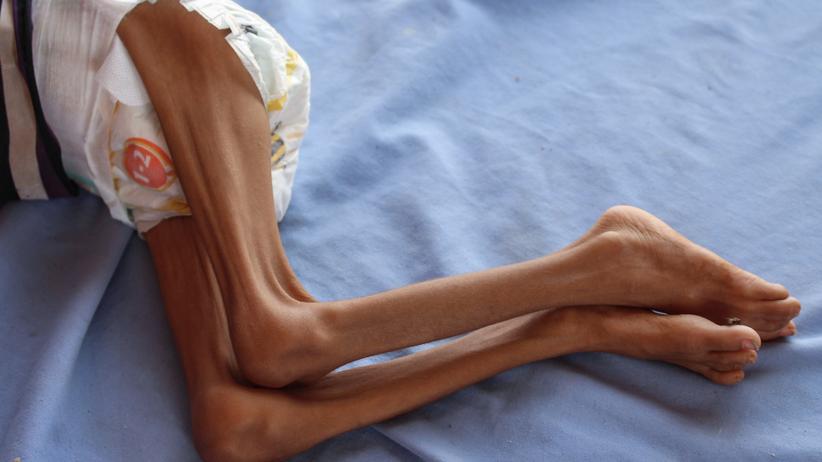 UN-Geberkonferenz: In einem Krankenhaus im nordwestlichen Hajjah hofft der zweijährige Bassem Mohamed Hassan auf dringend notwendige Hilfe.