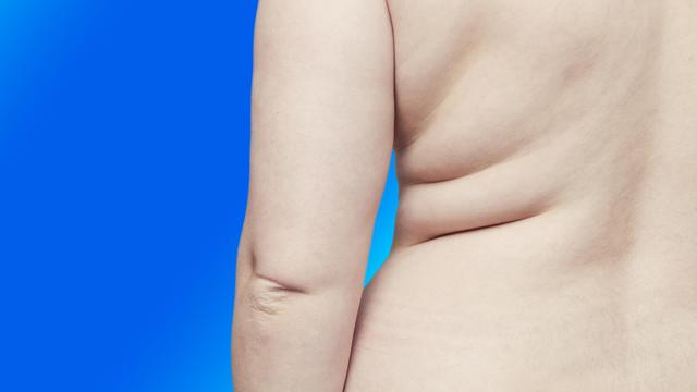 (+) Adipositas: Je höher das Körpergewicht, desto gefährlicher sind Infektionen