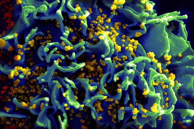 Aids HIV Neuinfektionen T-Zellen Virus