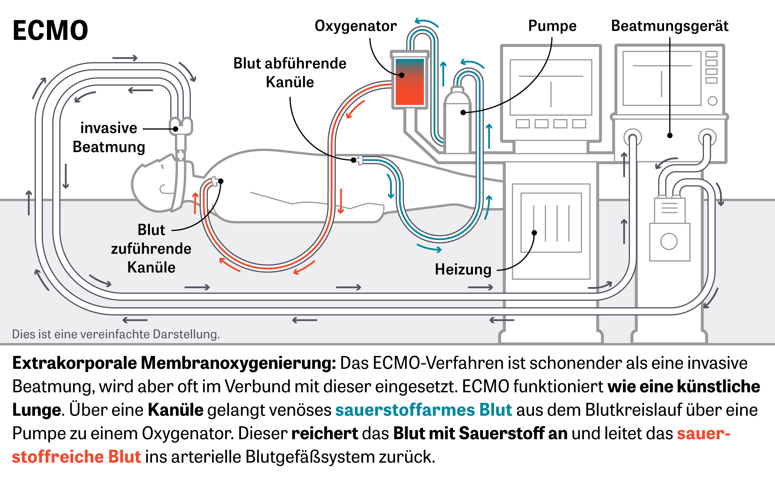 Beatmungstherapie: Extrakorporale Membranoxygenierung