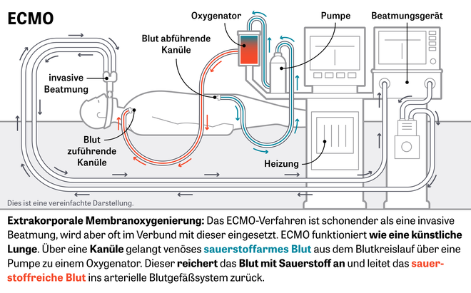 Beatmungstherapie: Extrakorporale Membranoxygenierung